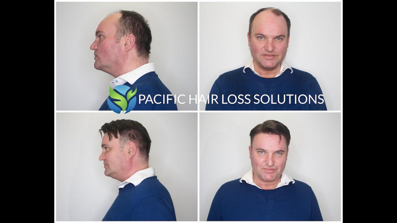 Unbelievable before & after men's hairpiece system transformation | Pacific Hair Loss Solutions