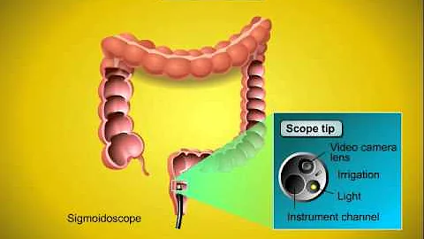 Come si fa per fare lo screening del colon retto?