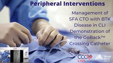 Management of SFA CTO with BTK Disease in CLI Demonstration of the GoBack™ Crossing Catheter