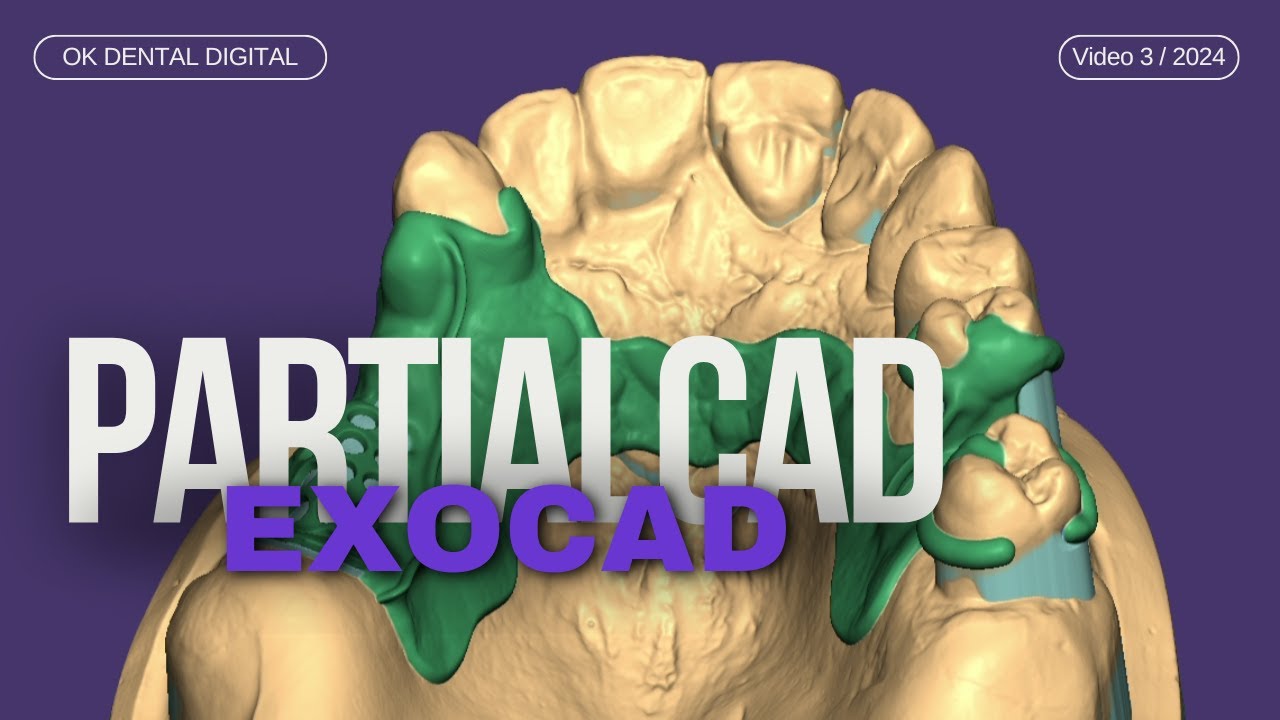 exocad partialcad diseño de estructura  con aditamento / structure design with attachment
