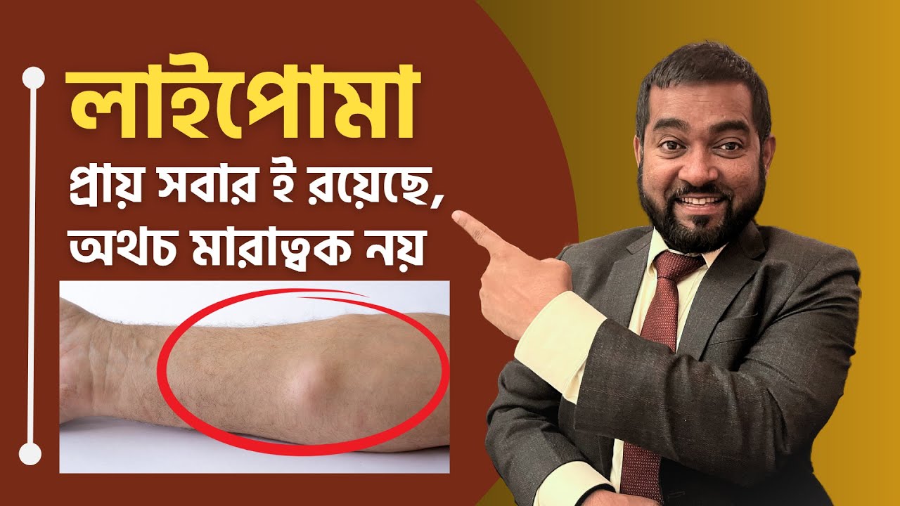 লাইপোমা থেকে সম্পুর্ণ মুক্তি পেতে দেখুন পুরো ভিডিও টি!  Dr Haque