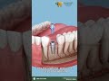 Dental Implants in Stamford, CT 🦷