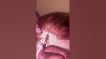 Thumbnail of HOW TO FIX A BALD SPOT IN YOUR LACE CLOSURE/FRONTAL WIG