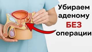 Аденома простаты. Как остановить рост аденомы БЕЗ операции и таблеток