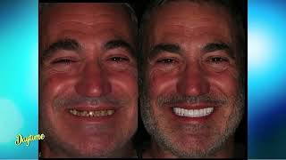 Dental Implant Surgery  BEFORE AND AFTER  with Dr. Alfonso Monarres Profile