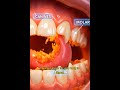 The Mouth: The First Step of Digestion