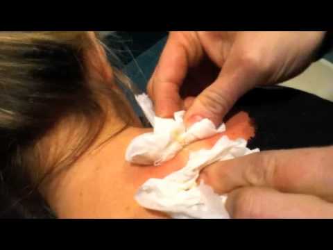 awesome pimple popping hilarity ( sebaceous cyst )