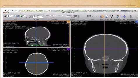 OsiriX for Neurosurgeons and Craniofacial surgeons