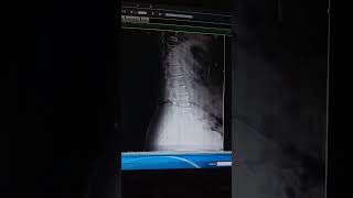 L spine ap & lat view x ray image complication swelling.
