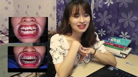 [NHẬT KÝ] Hành trình niềng răng 1 năm - Khớp cắn ngược