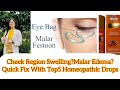 Malar edemamalar oedemafestoon swelling over cheek bone dr rukmanis treatments for malar edema