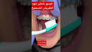 تقويم الأسنان : الطريقه الصحيحه السهله 🔥لتفريش الاسنان