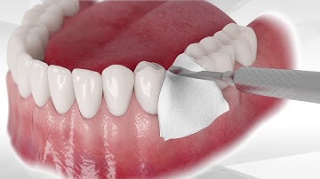 Best bone graft Bond Apatite protocol for socket grafting without flap reflection