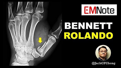 Bennett and Rolando Fractures of the Thumb
