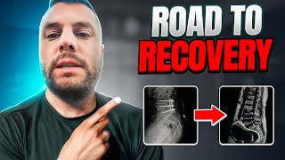 Overcoming the Challenges: Road to Recovery After Spinal Fusion