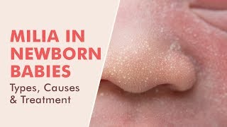 Milia in Newborn babies -  Causes, Types & Treatment