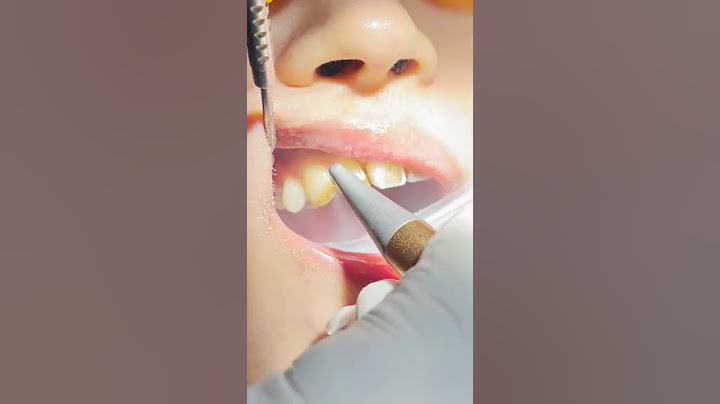 Severe Teeth Stain Removal