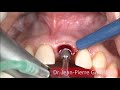 Implant deep conical