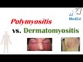 Idiopathic Inflammatory Myopathies | Polymyositis vs Dermatomyositis