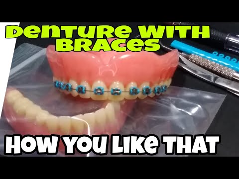 Denture With Braces, How to put Braces on Upper Complete Denture. Retainer like braces.