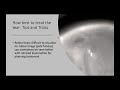 Webinar: Techniques and outcomes of laser retinopexy with Navilas® 577s