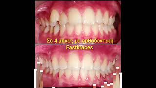 Fastbraces Neapoli Thessaloniki