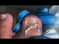 Professional toenails cleaning 
