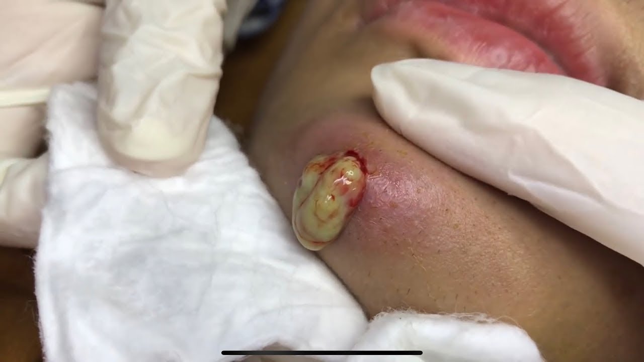 BOIL CYST