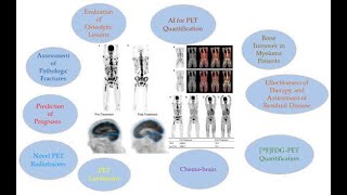 Valutazione neurologica per il mieloma multiplo - effetto sul sistema nervoso
