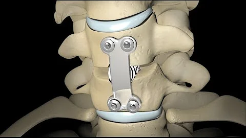 ¿Se sienten los tornillos después de una fusión espinal?
