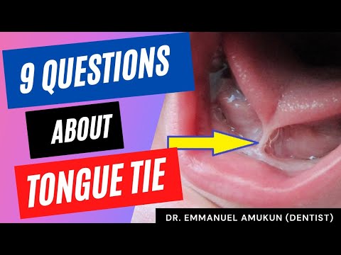 Answers to TOP 9 Tongue Tie Questions.