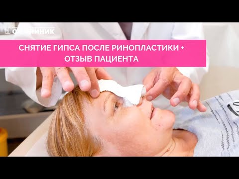 Ринопластика. Отзыв пациента + снятие гипса. Первая реакция на результат.