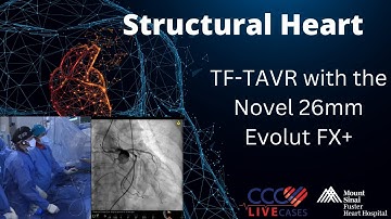 First Live Case in the World of﻿ TF-TAVR with the Novel 26mm Evolut FX+