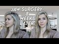 Jaw Surgery 8 WEEKS Later