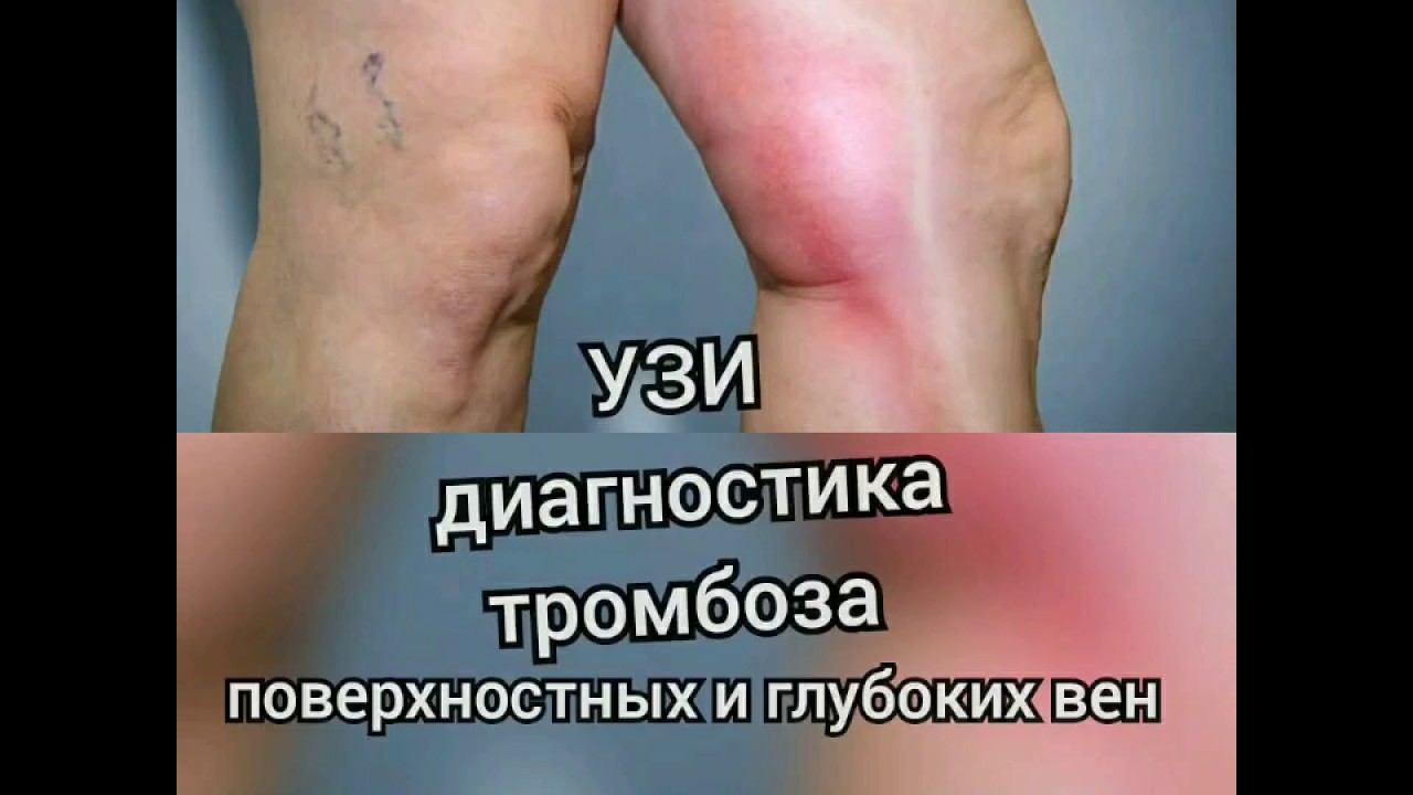 Как проявляется тромбоз нижних конечностей симптомы фото и лечение