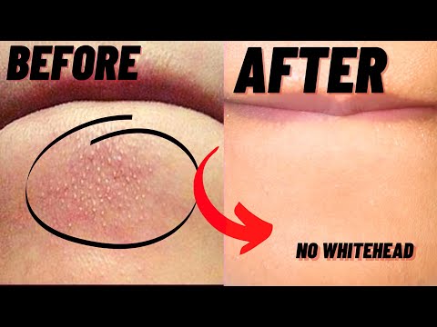 How To Remove Whiteheads And Blackheads From Chin At Home