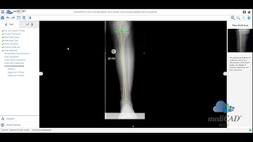 mediCAD Web 1.2 - Demovideo Knee Planning