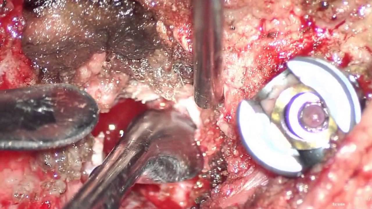 Copia de Congenital scoliosis camera iphone 8 plus apk