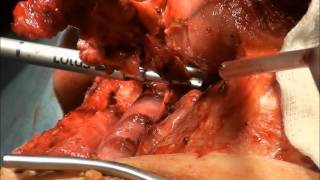Neck dissection surgery using the Lotus ultrasonic scalpel