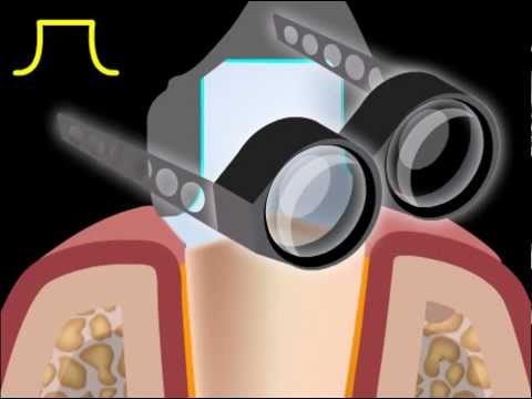 Video: Protetika Zubnej Korunky