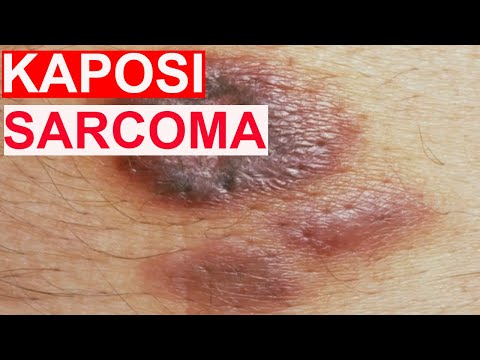 Video: Kaposis Sarkom - årsager, Symptomer, Typer, Diagnose Og Behandling Af Kaposis Sarkom