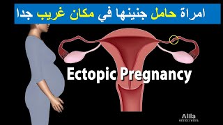 حالة نادرة جدا لحمل خارج الرحم في مكان غريب  shorts