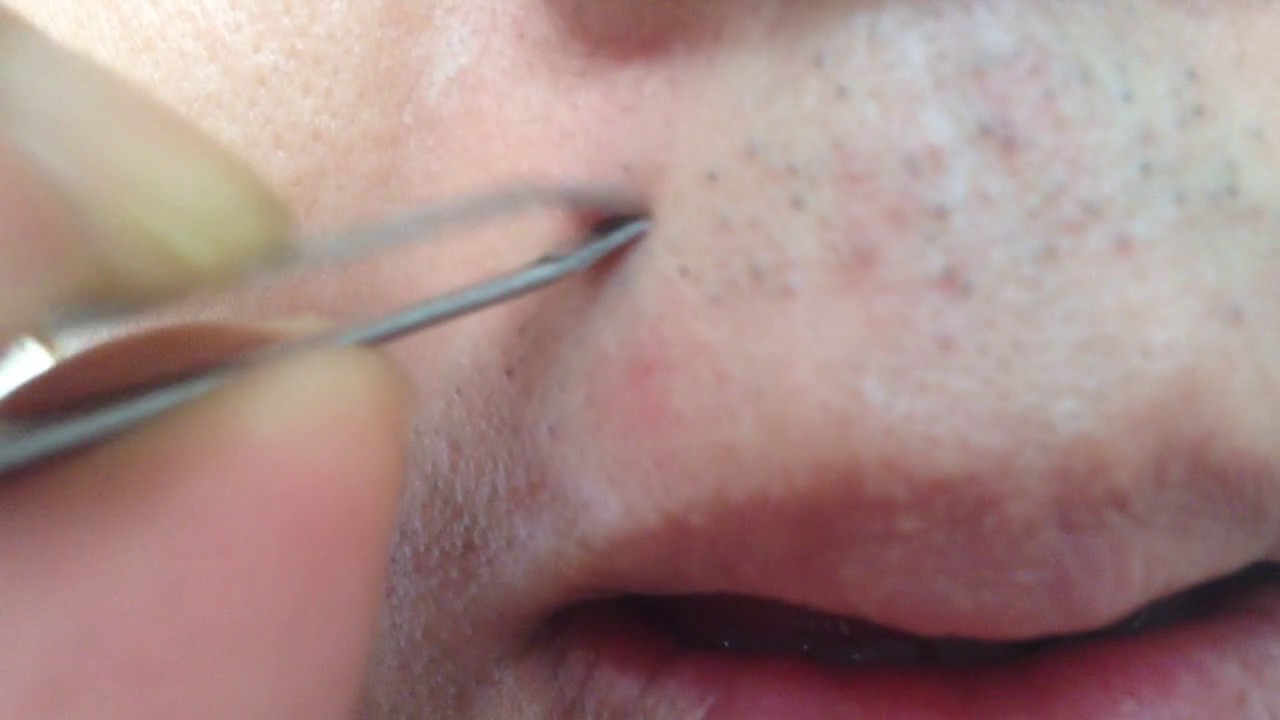 Plucking ingrown hair YouTube