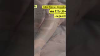 Say Goodbye to Varicose Veins Color Doppler Screening Explained!