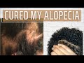 I cured my Alopecia Areata NATURALLY!! | iamnilsa