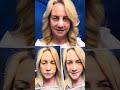 Revision Septorhinoplasty/Sinus Surgery/Ear cartilage graft-6 days ago and doing well