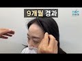 616번 비절개3800 여자헤어라인 미니미니 헤미니 Dr 정우석