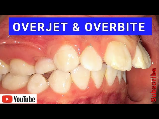 What is an overbite and what is an overjet? What is the difference?