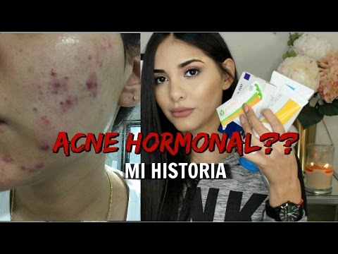 Acne hormonal ??? mi historia | Giovanna Espinoza