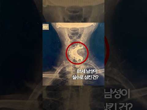 81세 남성이 실수로 삼킨 건? #shorts